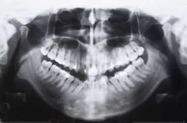 Radiografia dentale panoramica che mostra l'intera dentatura e le ossa mascellari.