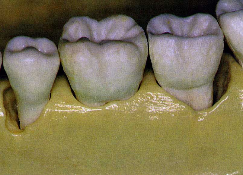 Tre corone dentali grigie su un modello di gengiva gialla, vista ravvicinata