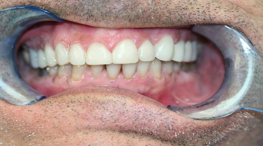 Primo piano di una bocca retratta da un divaricatore dentale metallico per le guance, che mostra denti e gengive.