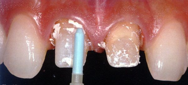 Primo piano dei denti frontali durante la pulizia dentale, con uno scaler blu su un dente scheggiato.