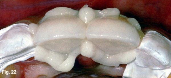 Primo piano di un modello dentale bianco con un ampio allineamento dei molari superiori su sfondo scuro.