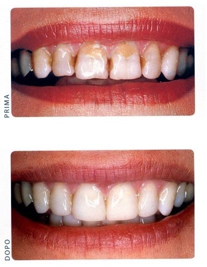 Primo piano dei denti prima e dopo, che mostra lo scolorimento nella parte superiore 