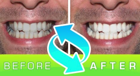 Primo piano del prima e dopo di un sorriso con denti più dritti e più bianchi, con una freccia blu tra le due immagini.