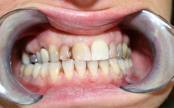 Bocca retratta con divaricatori odontoiatrici per le guance