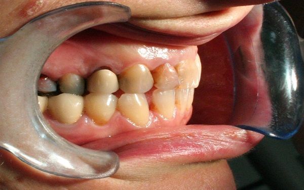 Primo piano di denti con grave affollamento e disallineamento, tenuti aperti con divaricatori dentali.