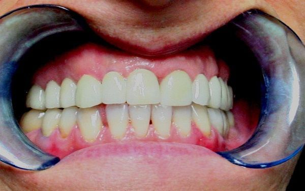 Bocca tenuta aperta con un divaricatore dentale, in modo da mostrare denti e gengive durante una visita.