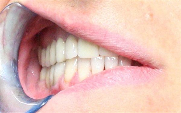 Primo piano di una bocca con uno specchietto dentale che riflette denti e gengive.