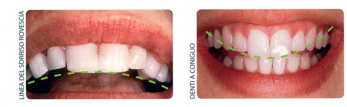 Primo piano di due bocche con apparecchi ortodontici, una con elastici neri e l'altra con elastici verdi.