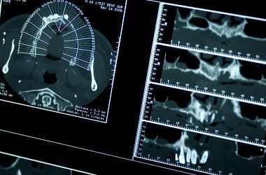 Immagini di una scansione medica visualizzate su un monitor, che mostrano sezioni trasversali di una TAC in scala di grigi.