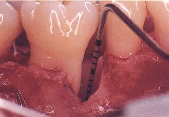 Primo piano dentale che mostra una sonda per misurare la profondità della tasca gengivale intorno a un dente