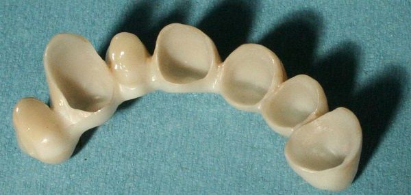 Ponte dentale bianco con più denti su sfondo blu