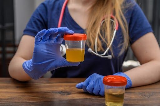 A nurse is holding a jar of urine next to a cup of urine.