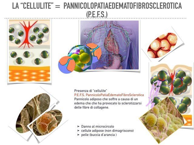 la cellulite