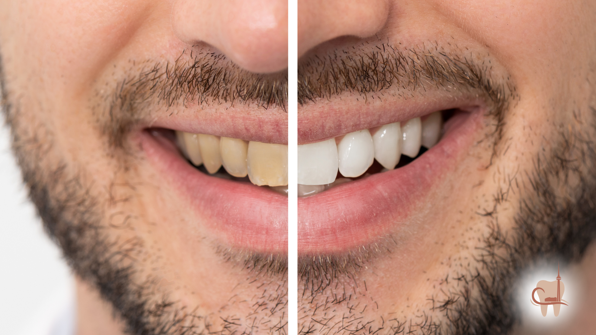 Split photo of a smiling man: one side shows yellow teeth, the other shows white teeth.