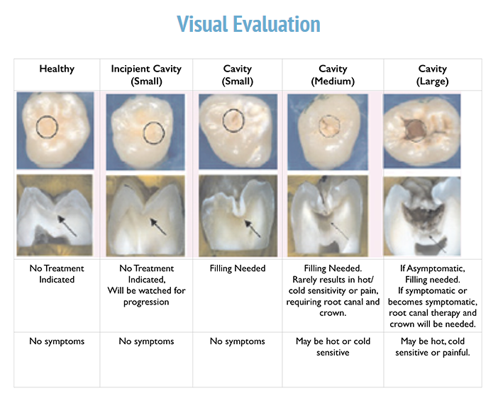 Why It's Important to Fix a Cavity When It Is Small