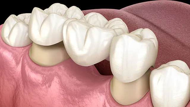 Best dentist for dental bridges in Topeka KS Dental bridges getting placed | Best dentist near me | Topeka KS 66614