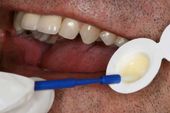 Best family dentist for fluoride treatments in Topeka KS Person's mouth open getting fluoride treatment in Topeka KS