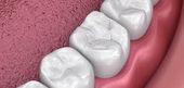 Tooth Fillings | Affordable Dentist in Topeka KS Teeth with tooth colored dental fillings | Topeka KS