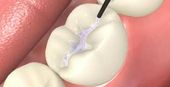 Protect your teeth with dental sealants in Topeka KS Tooth with dental sealant on it | Preventative dentist near me in Topeka KS