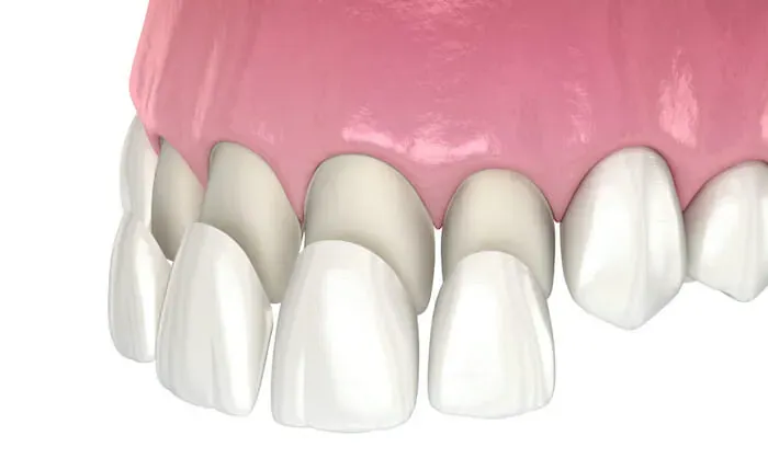 Get affordable veneers from our dentist in Topeka KS Image of Veneers Getting Places | Affordable dentist for veneers in Topeka KS