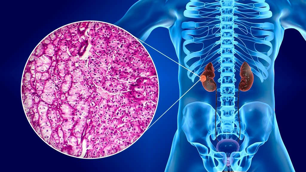 Cáncer de Riñón : Síntomas a los que se Deben Prestar Atención