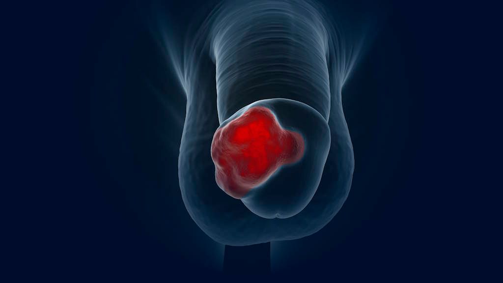 cáncer de pene
