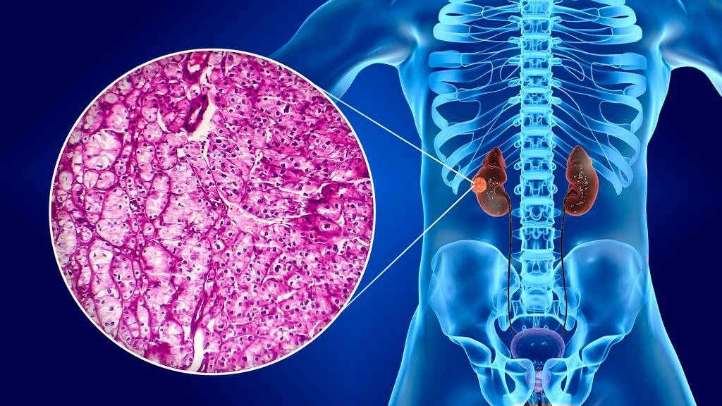 Cáncer de riñón