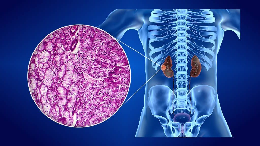 Cáncer de riñón