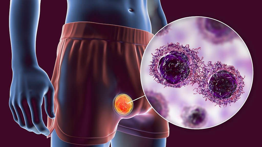 Cáncer de testículo