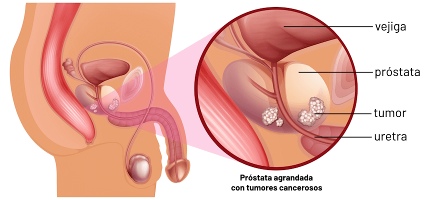 Cáncer de próstata