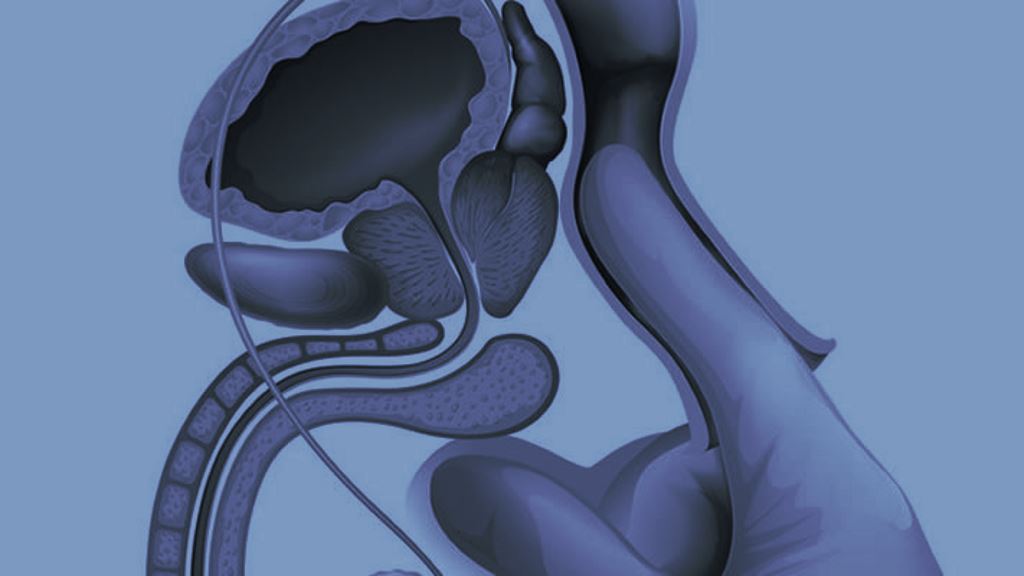 El Mito del Tacto Rectal