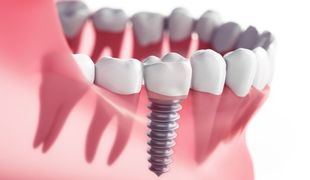 Periodontist — Dental implantation in Lexington, KY Periodontist — Dental implantation in Lexington, KY