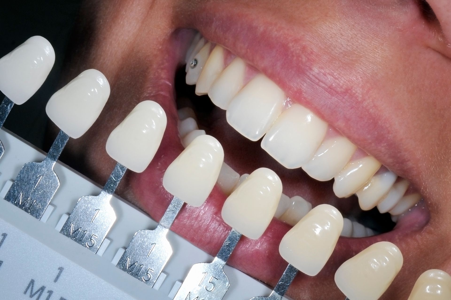 A close up of a person 's teeth with a tooth color chart in front of them
