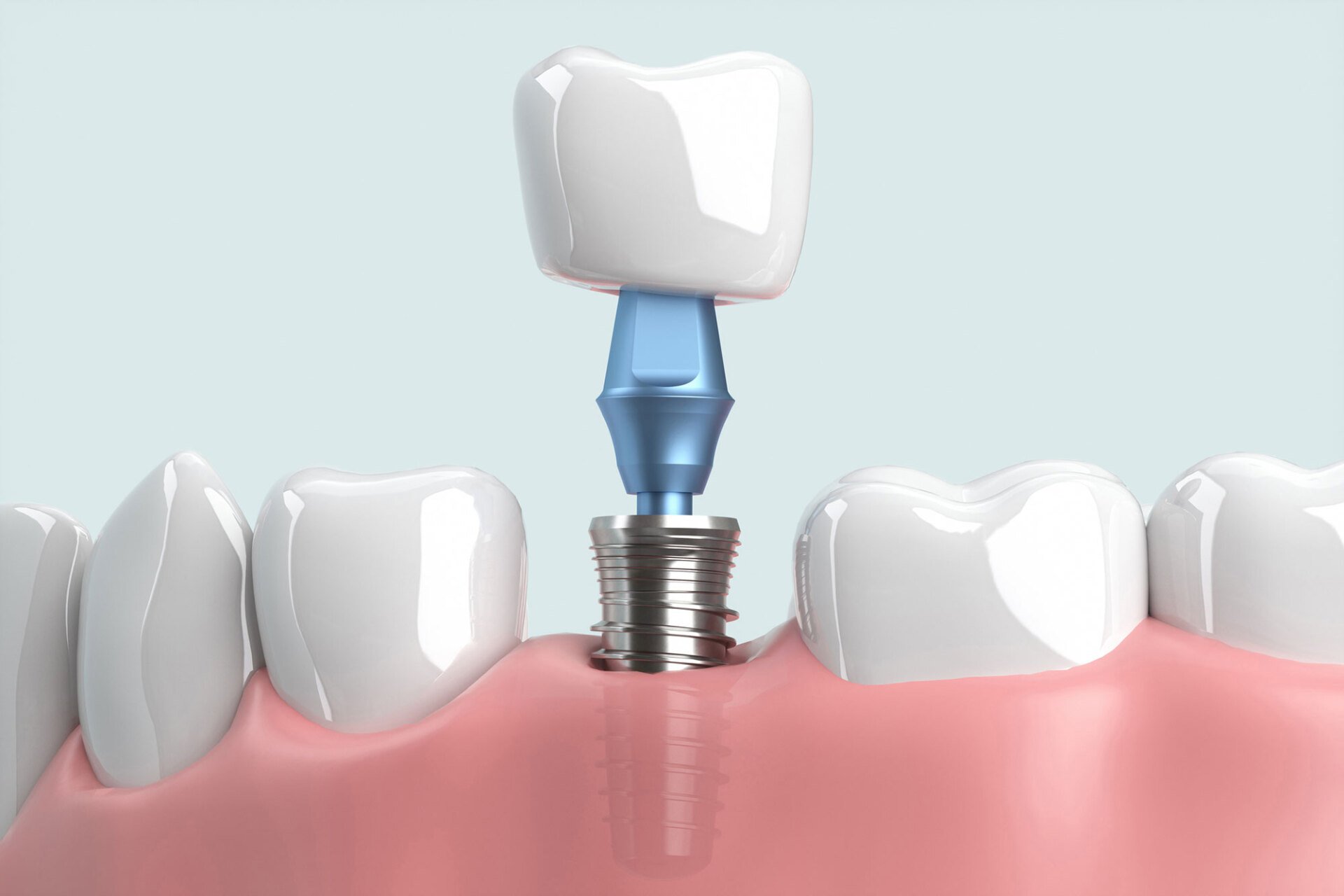 Dental Implants Jackson Heights, NY
