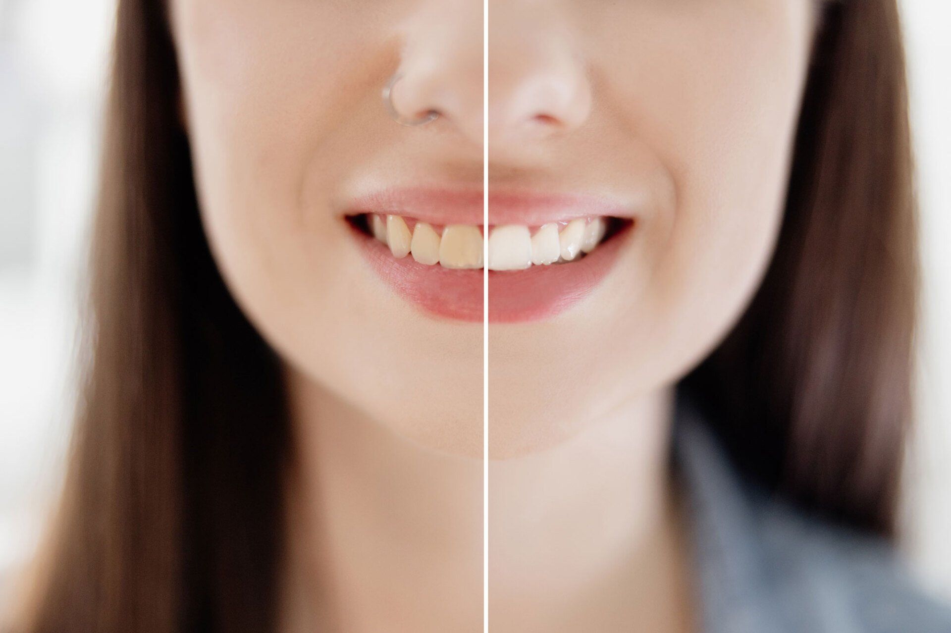 Implant Tooth Installation — Jackson Heights, NY — Vanguard and Achury Dental