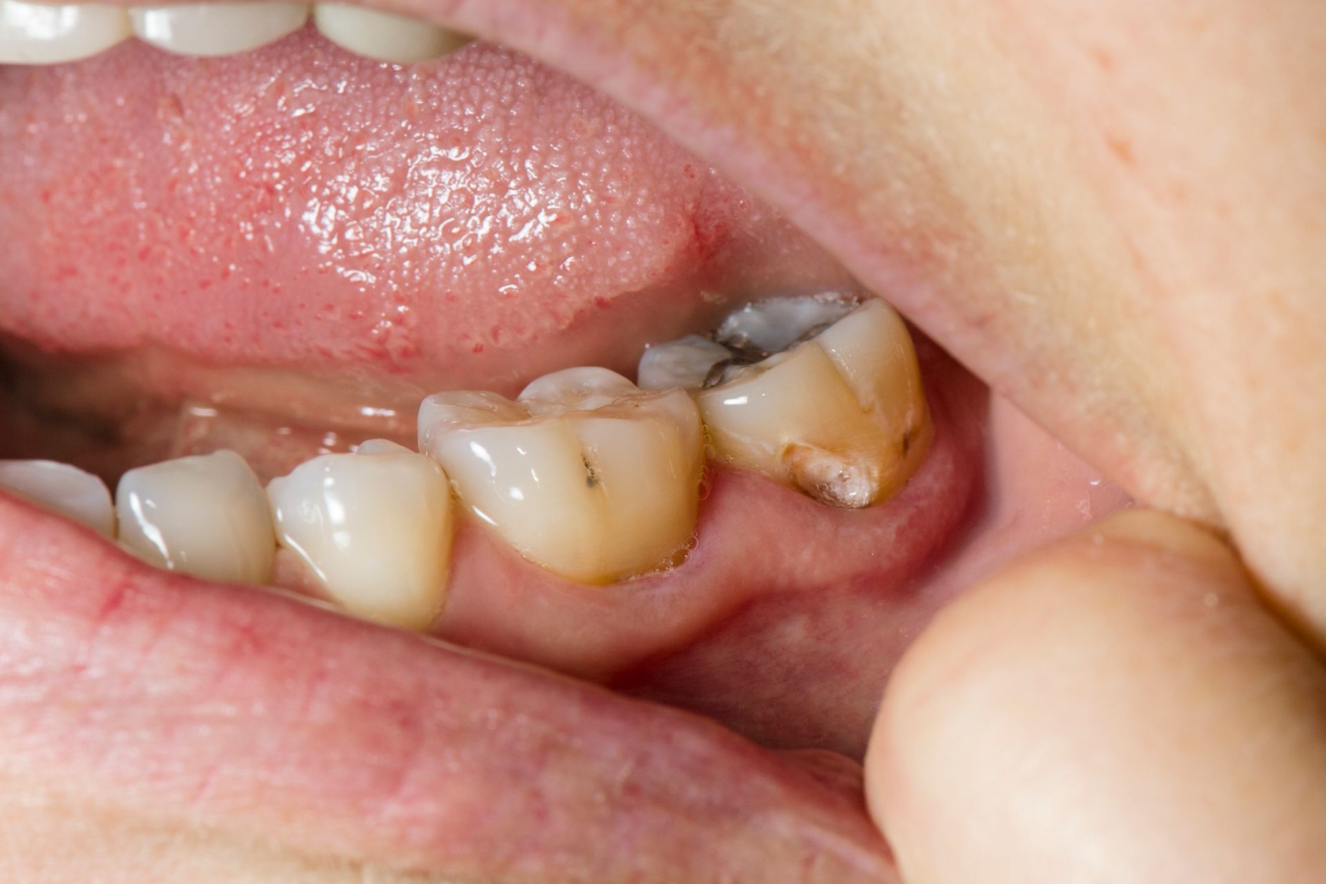 Close-up view of a mouth with a decayed molar, and other healthy teeth.
