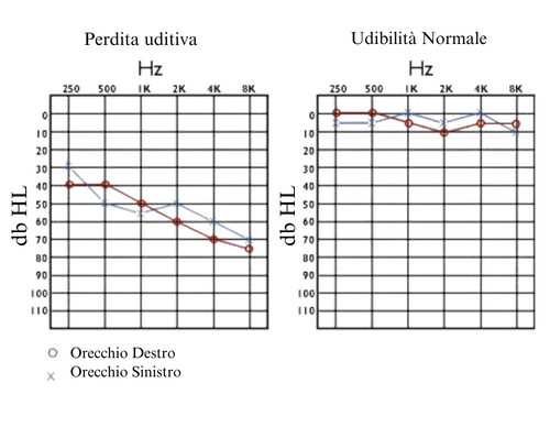 Grafici della perdita uditiva e dell'udibilità normale
