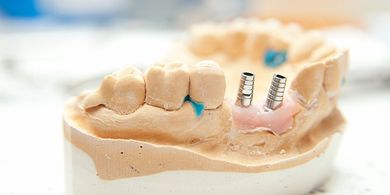 Dental Implants — Quincy, MI — Family Dental Home Dental Implants — Quincy, MI — Family Dental Home
