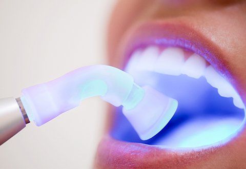 Dental Filling — Quincy, MI — Family Dental Home Dental Filling — Quincy, MI — Family Dental Home