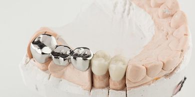 Crowns and Bridges — Quincy, MI — Family Dental Home