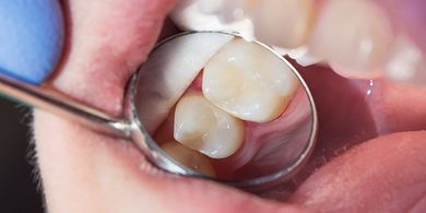 Dental Bridge — Quincy, MI — Family Dental Home