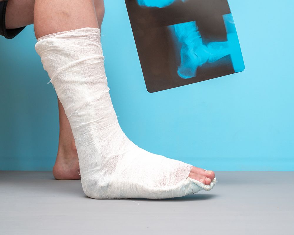 Ankle Fractures