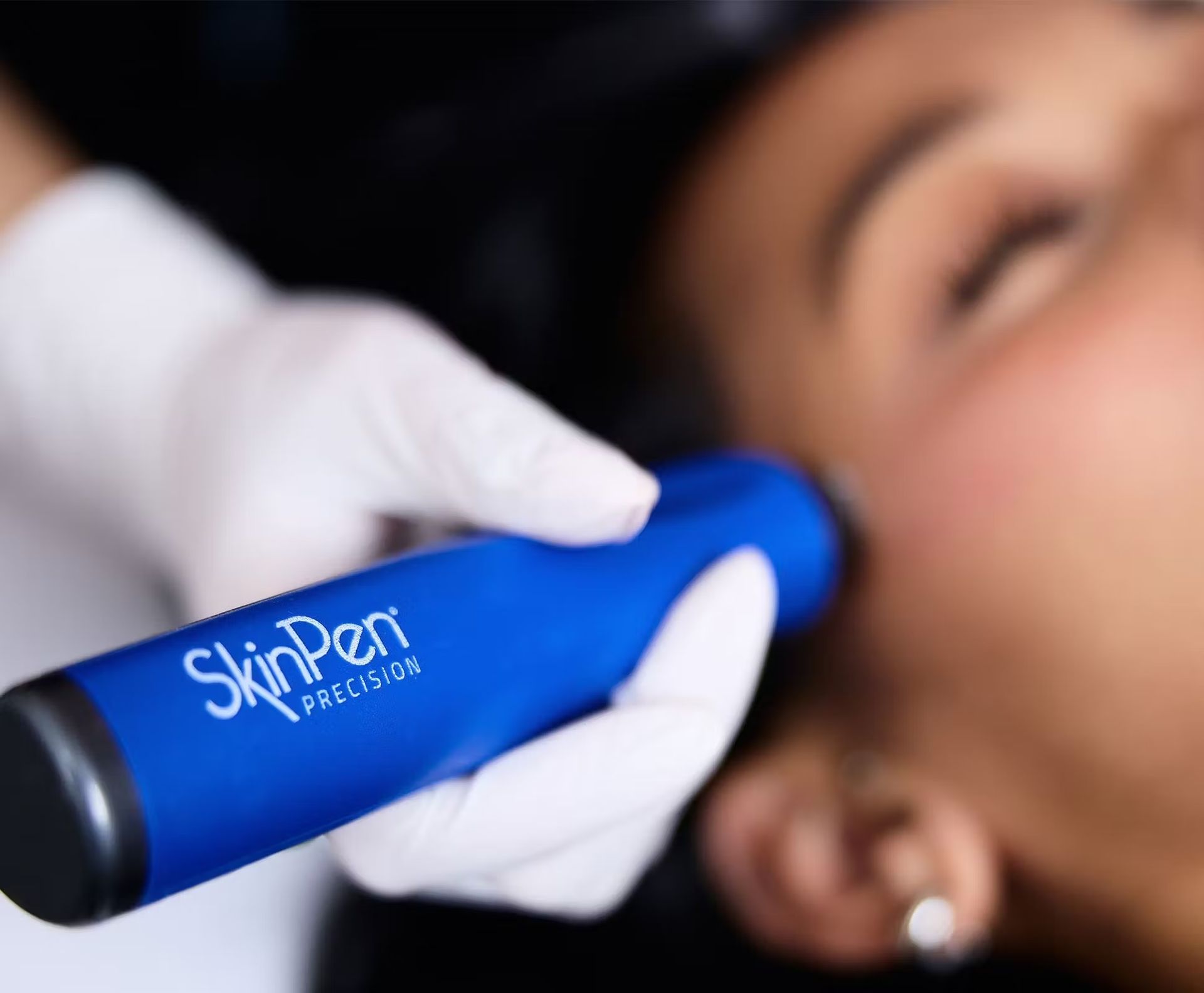 Gloved hands apply a blue SkinPen device to a patient’s cheek during a facial treatment