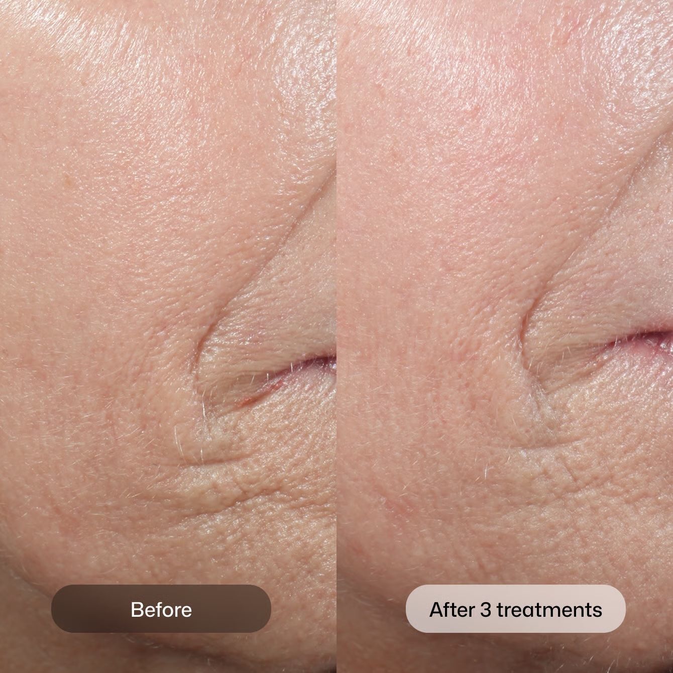 Close-up skin comparison labeled “Before” and “After 3 treatments,” showing reduced wrinkles.