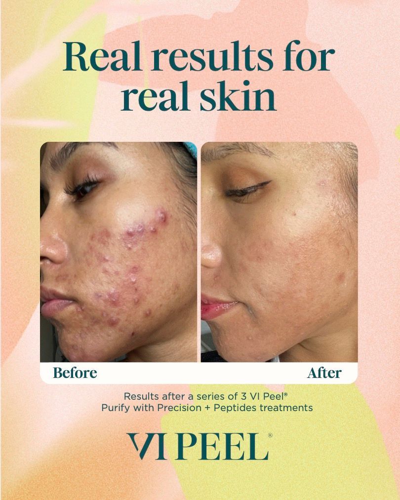 Before-and-after facial skin treatment results shown in two side-by-side three-photo comparison rows.