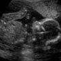 Grayscale ultrasound scan showing a fetus in profile with head and upper body visible