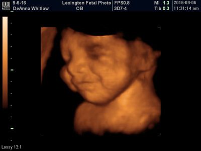 3D ultrasound scan of a fetus, showing the baby's face and upper body in warm orange tones