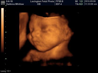 3D ultrasound scan of a fetus in the womb, shown in orange tones on a black background