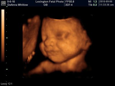 3D ultrasound scan of a fetus, showing the baby's face in warm brown tones