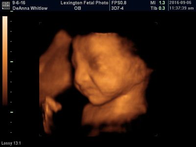 Ultrasound scan showing a fetus with a visible face and hand in warm orange tones.